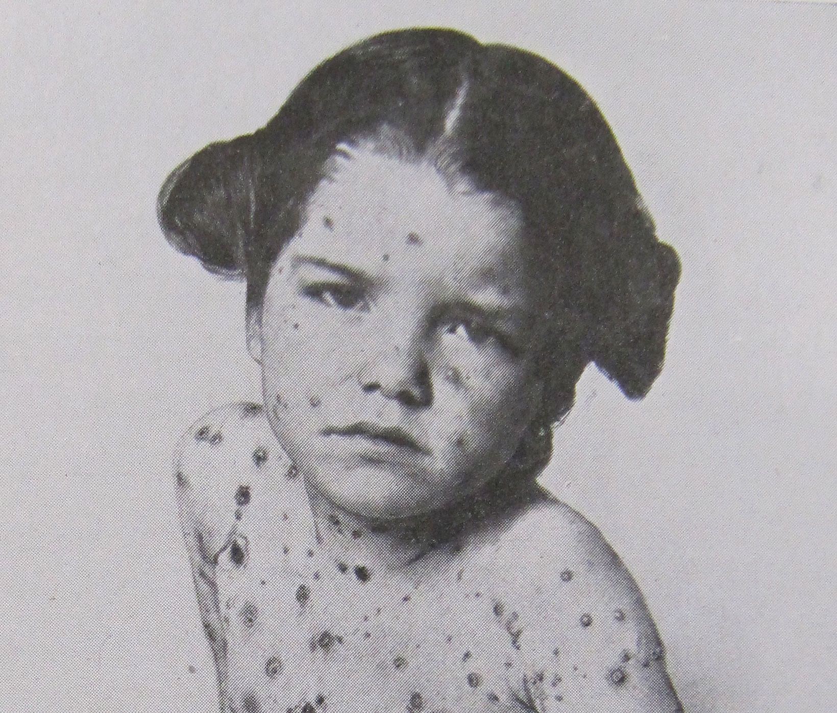 Chickenpox lesions on a girl's head and trunk