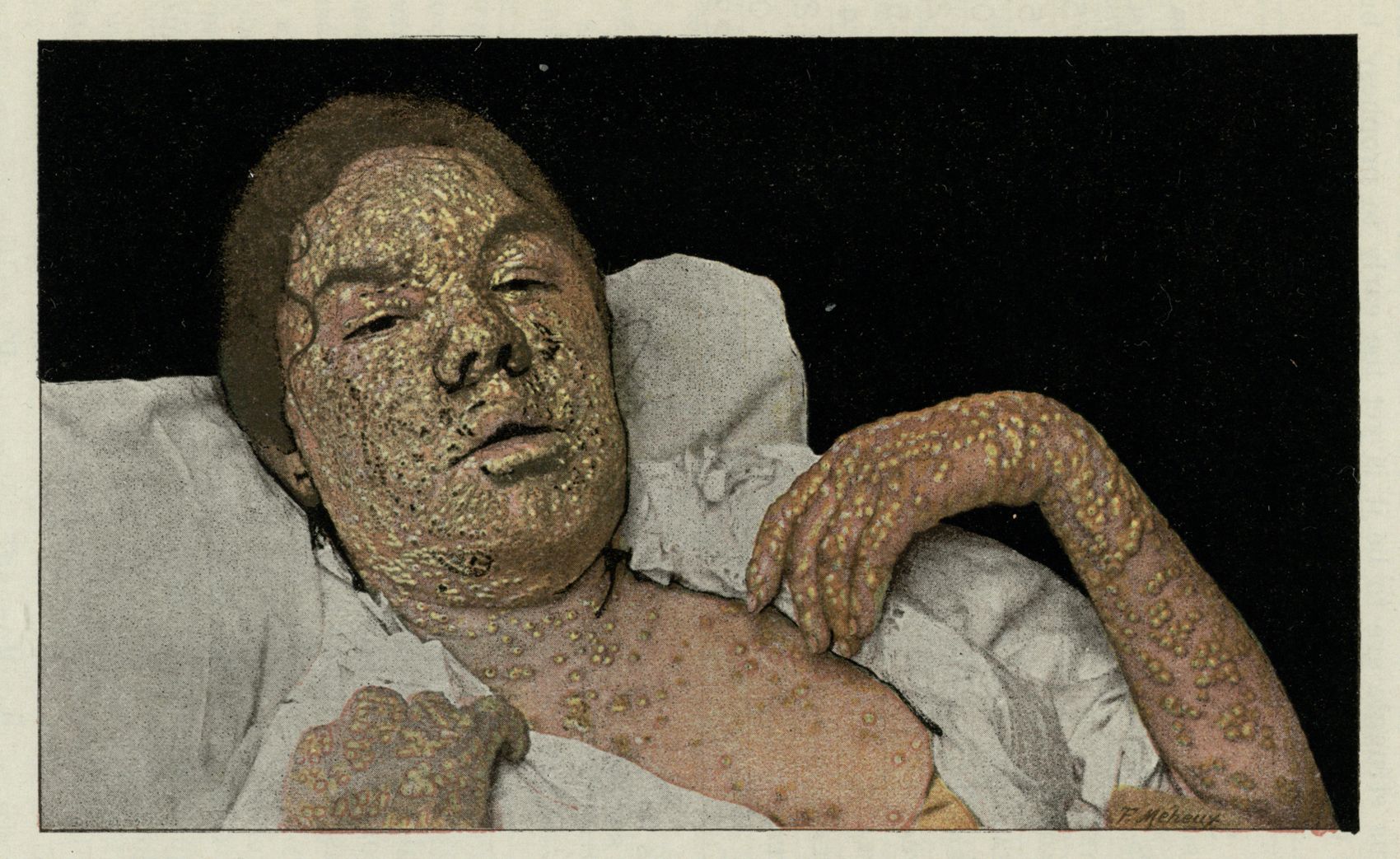 Illustration of woman with smallpox 