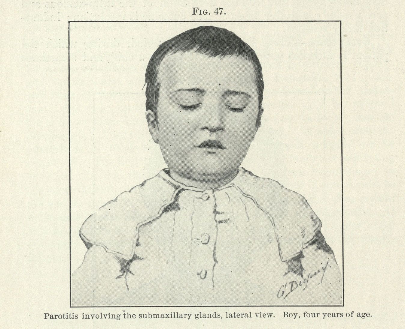 Depiction of swelling under young boy's jaw